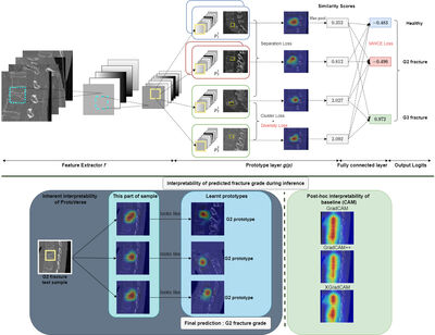 Enhancing Interpretability of Vertebrae Fracture Grading using Human-interpretable Prototypes cover file