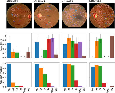 Looking into Concept Explanation Methods for Diabetic Retinopathy Classification cover file