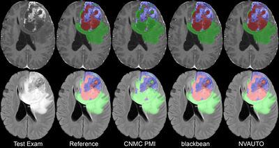 Analysis of the BraTS 2023 Intracranial Meningioma Segmentation Challenge cover file