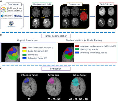 BraTS-PEDs: Results of the Multi-Consortium International Pediatric Brain Tumor Segmentation Challenge 2023  cover file