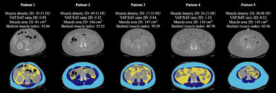 Automated Muscle and Fat Segmentation in Computed Tomography for Comprehensive Body Composition Analysis cover file