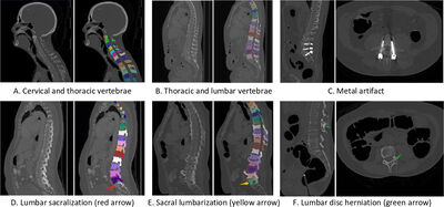CTSpine1K: A Large-Scale Dataset for Spinal Vertebrae Segmentation in Computed Tomography cover file
