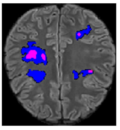 PediDemi - A Pediatric Demyelinating Lesion Segmentation Dataset cover file